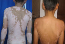 Чем опасны белые пятна на коже?