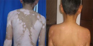 Чем опасны белые пятна на коже?