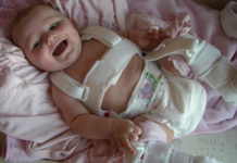 Врожденный вывих не приговор