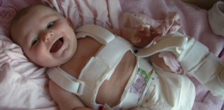 Врожденный вывих не приговор