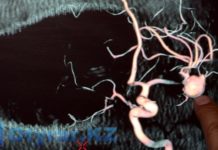 В ЮКО на учет поставили 1000 человек с болезнью Паркинсона