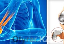 Титановые суставы в Шымкенте — реальность Титановый сустав