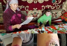 В ЮКО вернулся «забытый» лейшманиоз