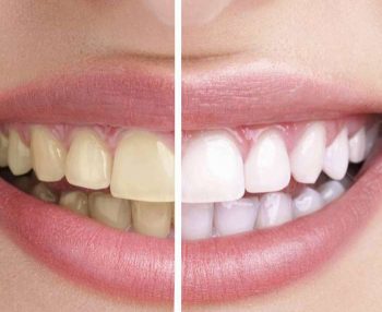Как сохранить зубы целыми и здоровыми