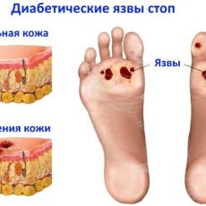 Диабетическая стопа при сахарном диабете Диабетическая стопа