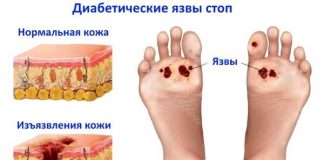 Диабетическая стопа при сахарном диабете Диабетическая стопа