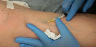 Флебология и всё о лечении варикоза Флебология