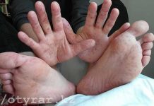 Новый вирус «руки-ноги-рот» Вирус Коксаки