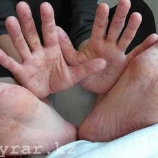 Новый вирус «руки-ноги-рот» Вирус Коксаки