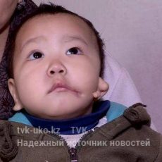 В Шымкенте мальчику, рожденному с ухом на щеке, нужна операция Ребенку требуется операция