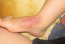 В Шымкенте ребенок получил сильные ожоги на городской улице