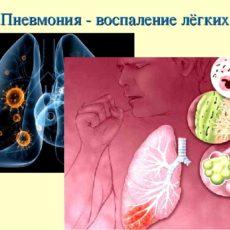 За прошедшие сутки в Казахстане выявлены 79 заболевших коронавирусом пневмония