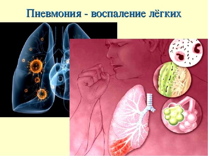 Пневмония на фоне иммунодефицита