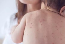 Стартует дополнительная массовая вакцинация от кори корь