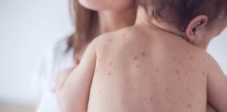 Стартует дополнительная массовая вакцинация от кори корь