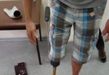 Алматинские специалисты сделали протез ноги по 3D-технологиям