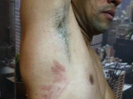 Фото травмы игрока после скандального пенальти в матче с "Шахтером"