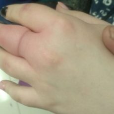 Спасатели помогли жительнице Шымкента снять кольцо с пальца снимают кольцо