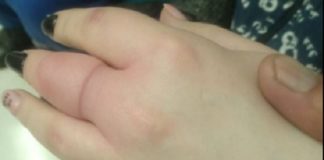 Спасатели помогли жительнице Шымкента снять кольцо с пальца снимают кольцо