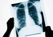 В Казахстане наблюдаются большие очереди на КТ легких рентген легких