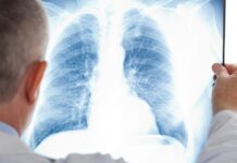 14 человек умерли от коронавируса за сутки в Казахстане пневмония