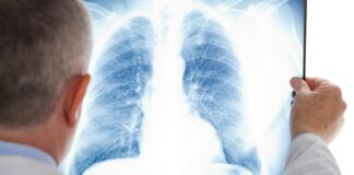 Туркестан: Около трех тысяч больных вылечились от пневмонии пневмония