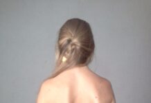 10-летней девочке в Шымкенте провели сложнейшую операцию на позвоночнике сколиоз