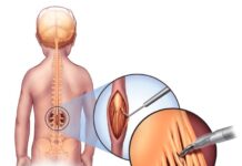 Детей с ДЦП будут оперировать в Шымкенте дцп