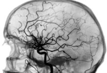 Ребенка с болезнью мойя-мойя впервые прооперировали в Шымкенте