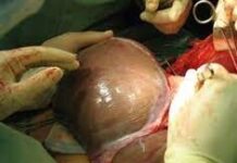 Шымкентские врачи провели успешную пересадку печени