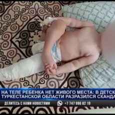 Из детского сада прямиком на операционный стол. Ребенок в Туркестанской области получил травмы