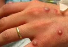 Будут ли казахстанцев вакцинировать от оспы обезьян