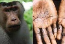 Оспу обезьян выявили в России