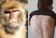 Главный санврач РК подписал постановление по предупреждению распространения оспы обезьян