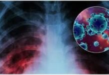 В Шымкенте стали чаще болеть туберкулезом туберкулез