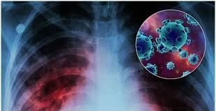 Как защитить себя от туберкулеза туберкулез