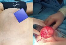 Грудь росла стремительно. Девочке-подростку удалили опухоль в Шымкенте