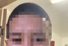 Подросток засунул себе в нос кольцо и не смог его снять