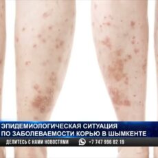 Санэпидемиологи о мерах профилактики кори