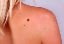 «Черная королева опухолей»: как обезопасить себя от рака кожи