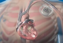 Первую имплантацию прибора на сердце провели в Шымкенте