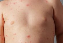 В Шымкенте растет заболеваемость корью