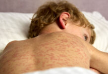 В Шымкенте проводится массовая иммунизация против кори