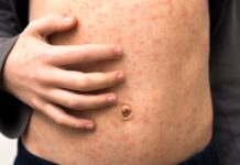 В Шымкенте запустили дополнительную вакцинацию против кори