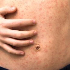 В Шымкенте запустили дополнительную вакцинацию против кори