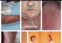 Неизвестные препараты довели женщину в Шымкенте до тяжелой аллергии