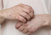 Эпидситуация с корью в Шымкенте пошла на спад