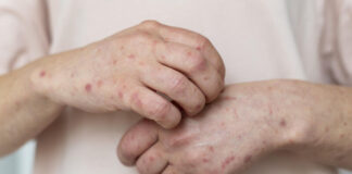 Эпидситуация с корью в Шымкенте пошла на спад