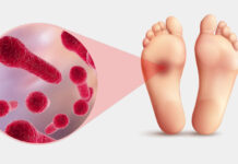 Почти забытый столбняк