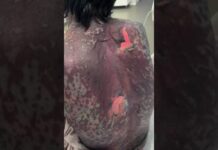 Шымкентские врачи спасли женщину после опасного самолечения